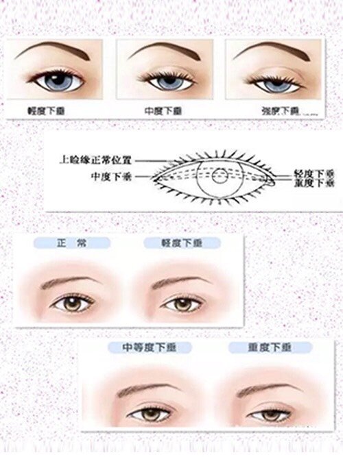 "上睑提肌"手术是什么?