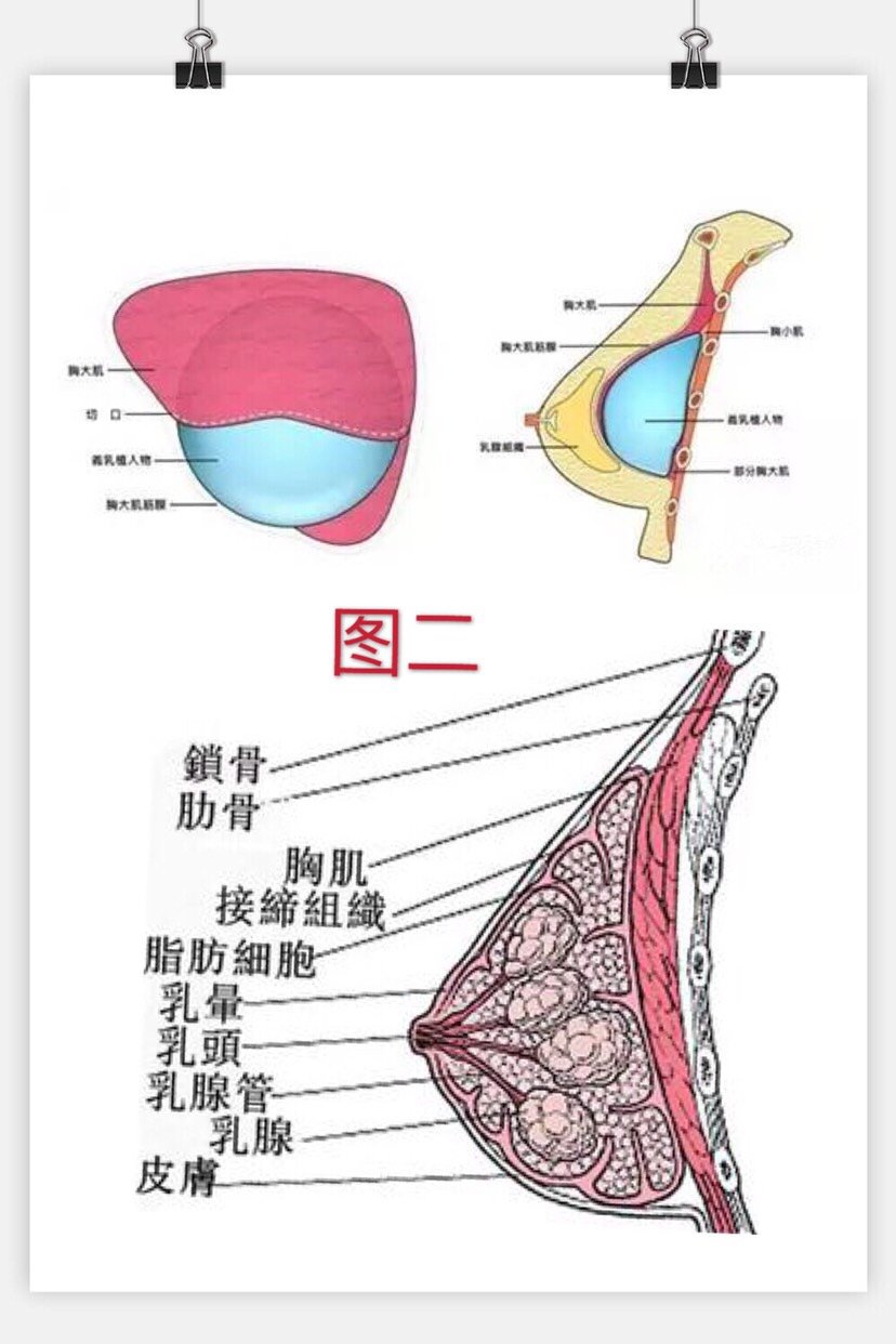 4.乳房假体有哪些形状?(看图)