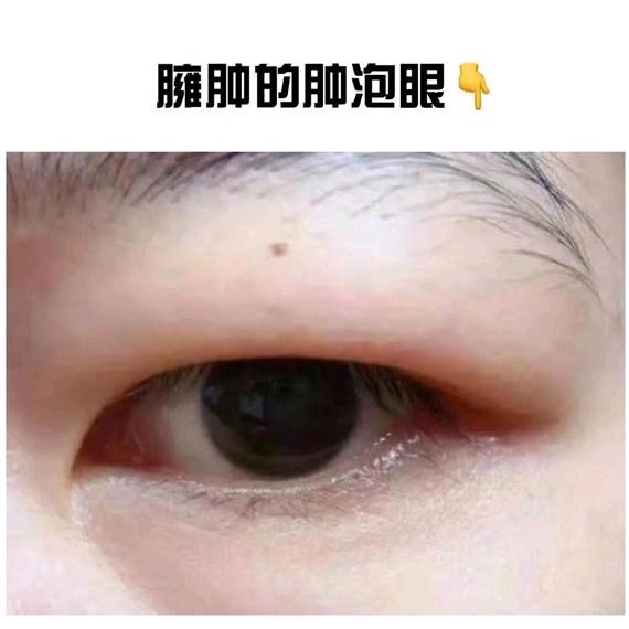 肿眼泡的形成因素有先天与后天之分,一种是先天性"肿泡眼,一种是后天