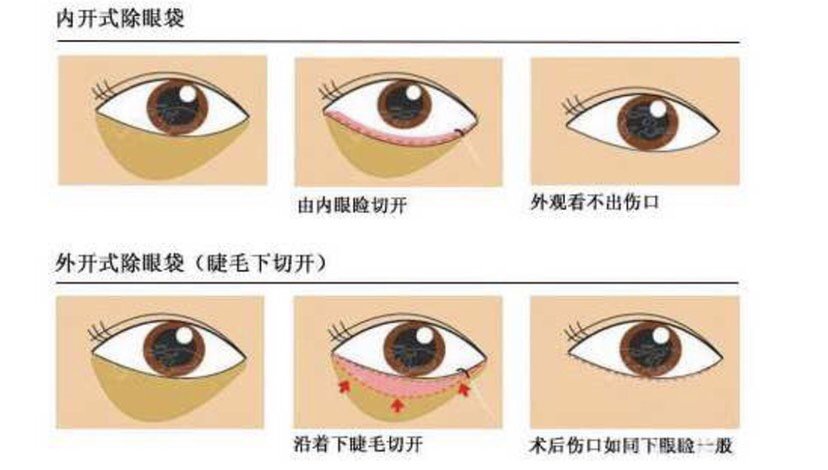 2-3毫米的地方切口,去眼袋手术是去除多余的眶膈脂肪,眼轮匝肌和松弛