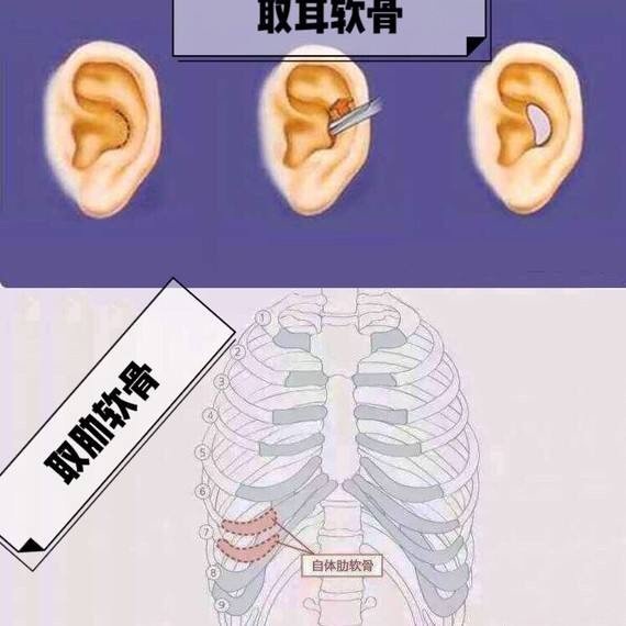 好像现在很多人更加愿意做肋软骨隆鼻手术了肋软骨隆鼻比耳软骨隆鼻好