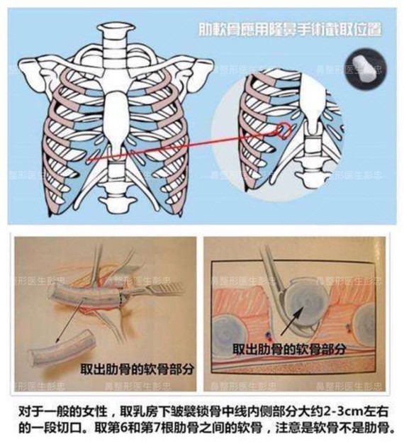 在临床经验上看,肋软骨隆鼻是最安全的隆鼻方式.