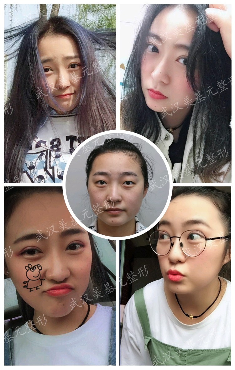 想问一下眼睑下至术是什么?和开眼角有什么区别吗?