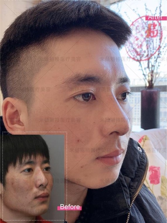 你好,照片看你额头不饱满,下巴短,鼻子不高挺,所以整个面部看着不立体