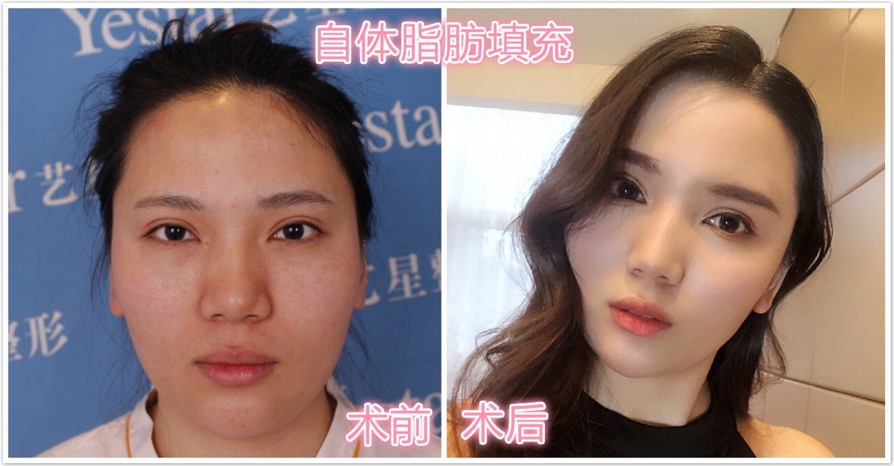 改善面部的不对称畸形 用于先天性发育不对称,后天的颜面半侧萎缩