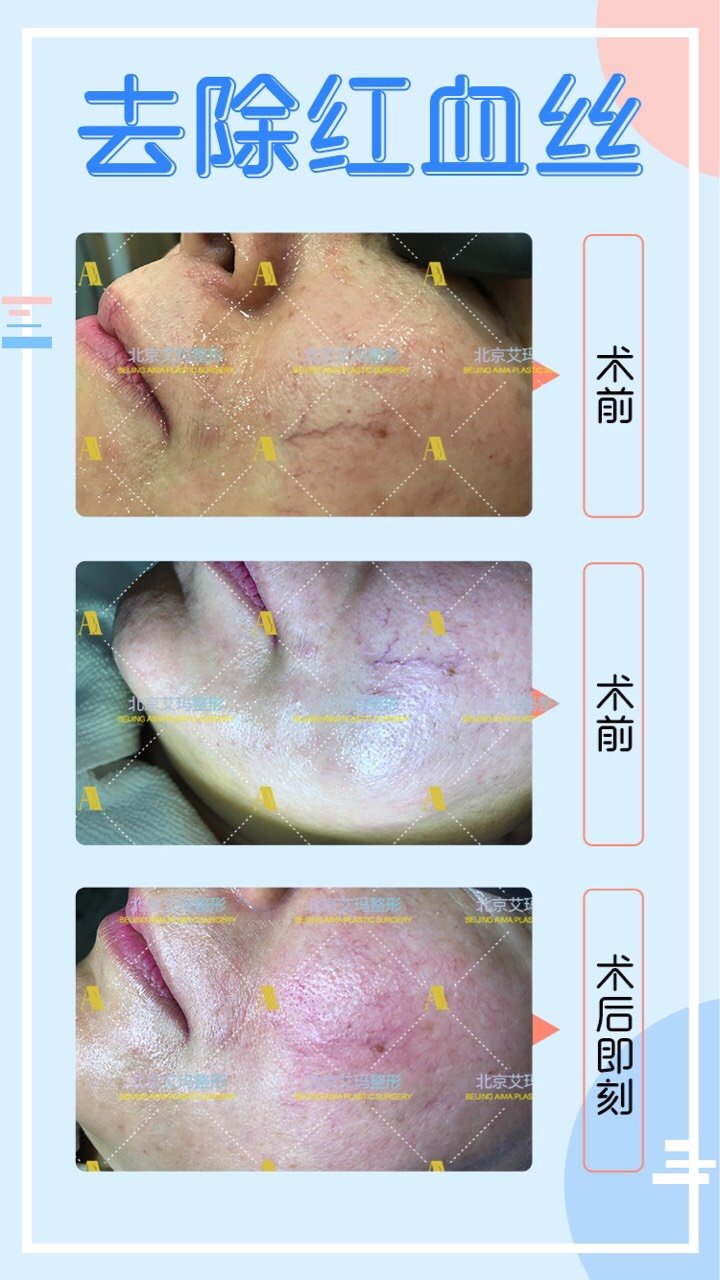 光子嫩肤可以去除红血丝嘛