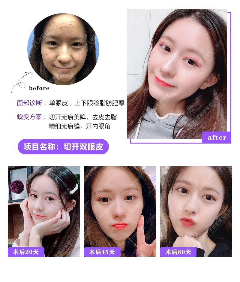 我准备只弄韩式三点,因为还要上学,韩式三点消肿是多长时间?