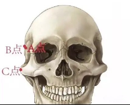 从照片上来看,您的颧弓外翻了,颧突点比较高,所以显得太阳穴有点儿