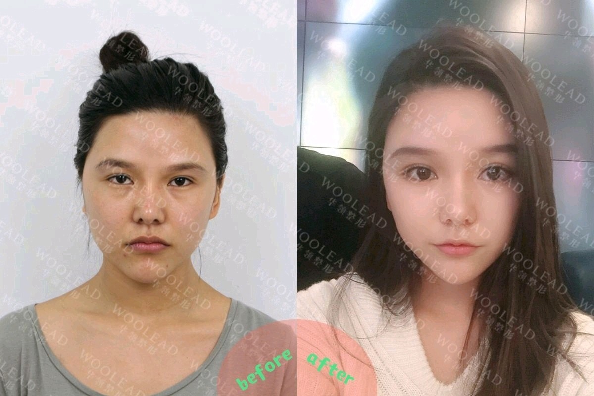 脸部填充玻尿酸好还是自体脂肪好