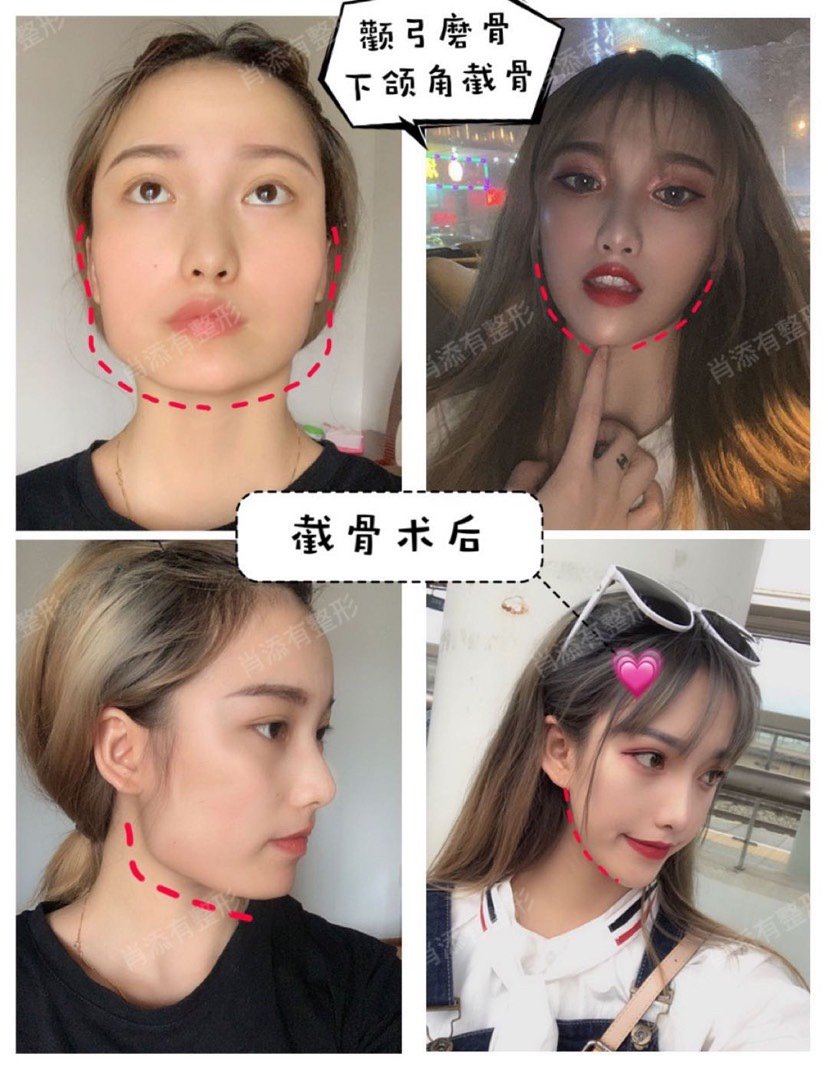 你的颧弓外扩比价哦明显,比下面的下颌角宽,是可以通过颧弓磨骨来改善
