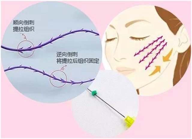 做完线雕后能听到砰砰的声音这种情况是线断了么