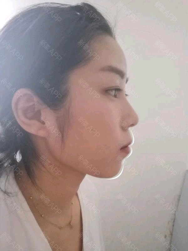 求看脸眼突嘴突颧骨外扩左右完全不对称的脸还能怎么救