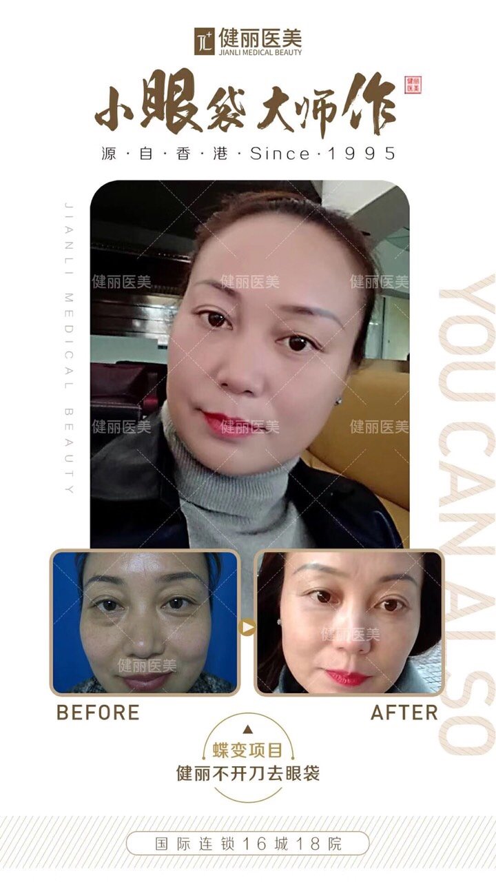 泪沟是什么?