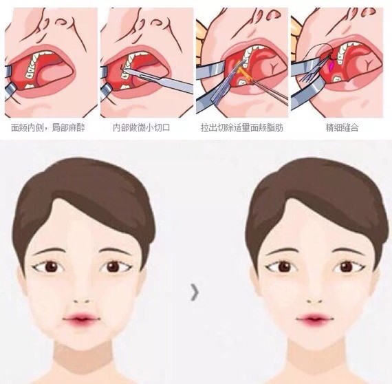 作为各个肌肉交叉点的一种颊脂垫颊脂垫位置图颊脂垫尖位置真人图颊脂