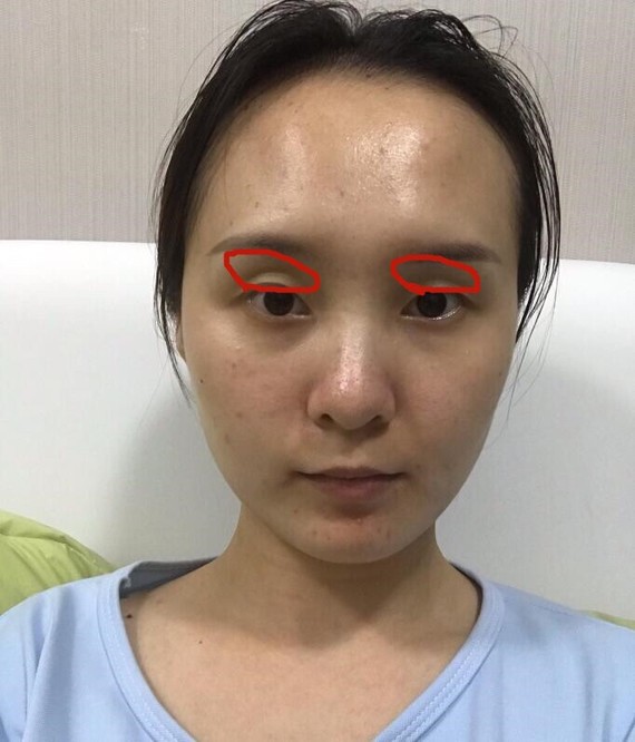 问题二:眼骨凸出,眼眶凹陷