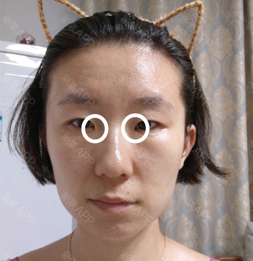单眼皮无神,单侧脸下垂,怎么可以更有女人味,更机灵,不要再做大龄单身