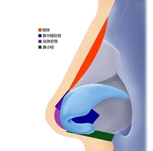 对鼻子不同部位,如鼻梁,鼻尖,鼻小柱等,采用假体,鼻中隔软骨,肋软骨