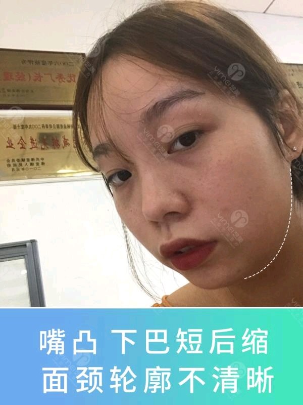 脸比较歪,嘴凸还下巴后缩,怎么微调可以变好看点?