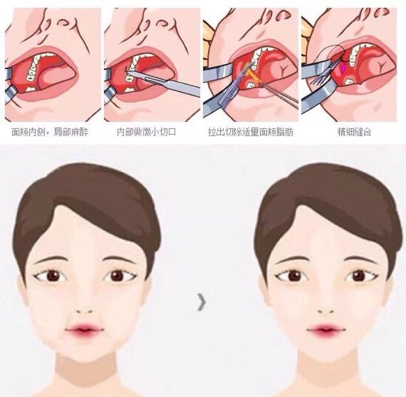 去颊脂垫和面部吸脂的效果有什么不同?