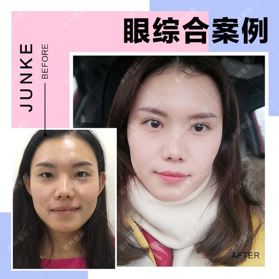 并不是所有的脸型都适合平扇形双眼皮,平扇双眼皮比较