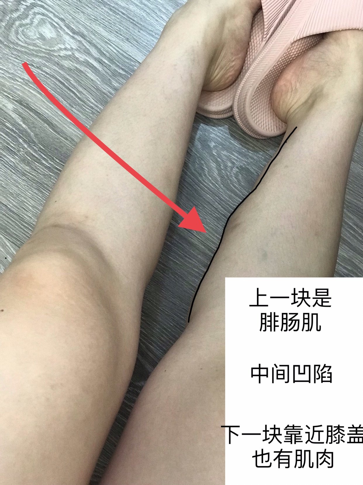 瘦腿针注射后为何会有腿部肌肉凹凸不平的问题?