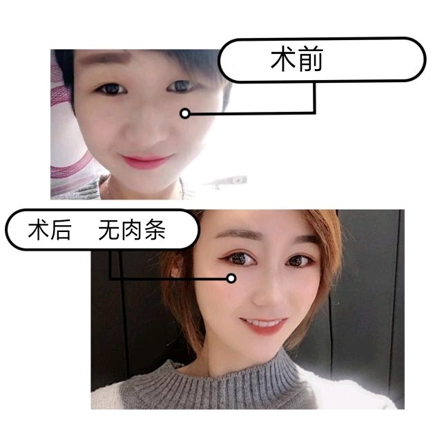 杏眼内双适合割双眼皮吗杏仁眼适合什么双眼皮