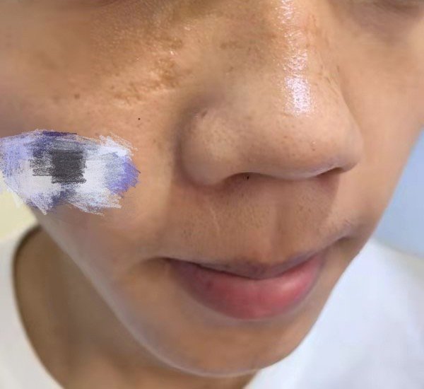凹陷型疤痕应该如何来修复