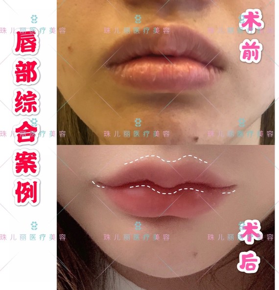 嘴唇两侧不对称能否通过唇部整形手术来改善呢?