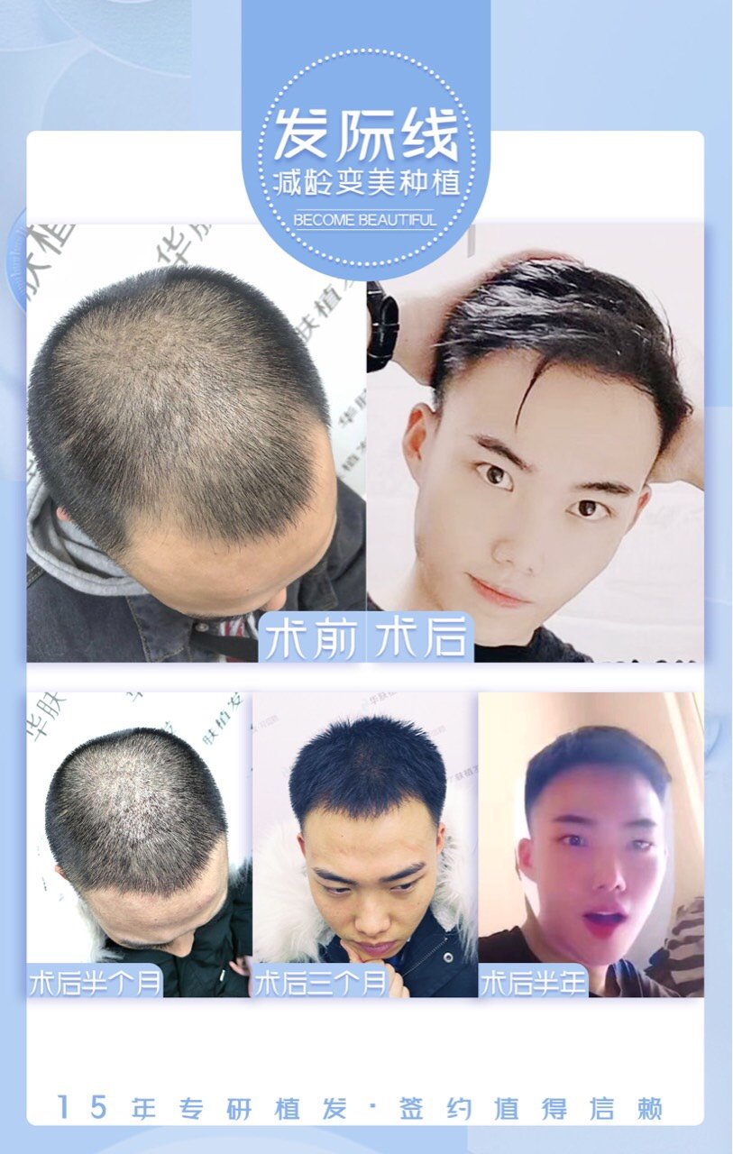 附上本院植发的案例,亲可以看一下.