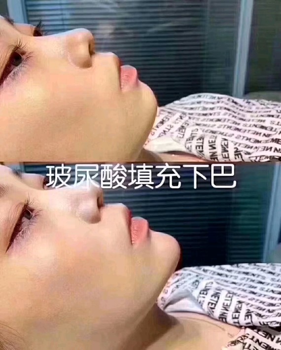 玻尿酸丰下巴对比图  为什么大家这么重视下巴  有下巴和没下巴的区别