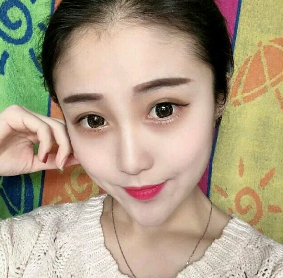 眼睛大小不一的矫正方法有哪些71166.双眼皮手术.