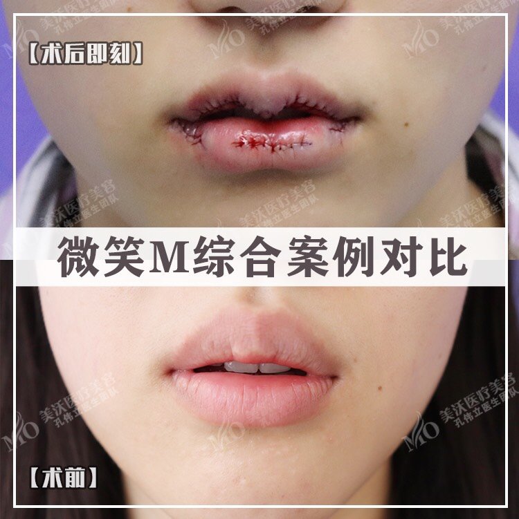 因为医生在缝合时没有将缝合处隐蔽在口内,导致厚唇改薄术后疤痕外露