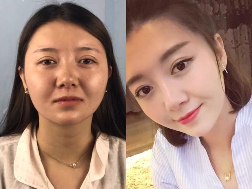 双眼皮失败有那几种情况,什么时候才能修复