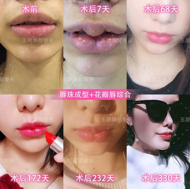 改善嘴唇偏薄的情况,然后通过上唇m唇塑形重塑迷人唇峰唇珠以及优美的