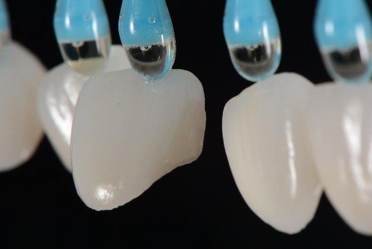 传说中的"6d炫彩浮雕牙"失败后前牙全瓷贴面修复.