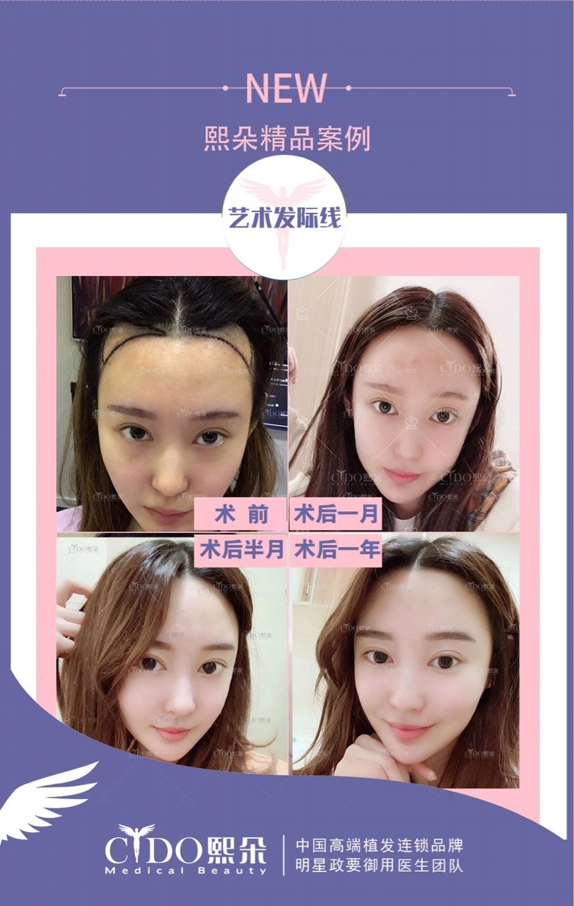 附上本院植发的案例,亲可以参考一下