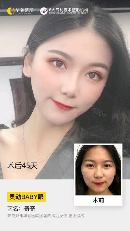 刚做完双眼皮,肿胀,左右眼不一样