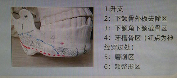 精准颌骨分区不损伤面部组织的情况下,采用从口腔内入路磨掉或者切除