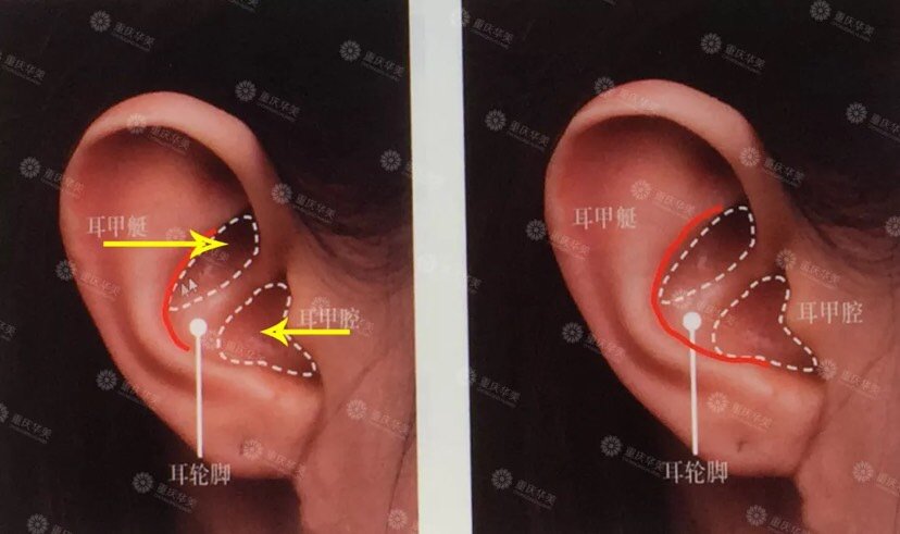 其实,取耳软骨一般选择耳甲腔,耳甲艇两个位置(下图白色虚线内),最大