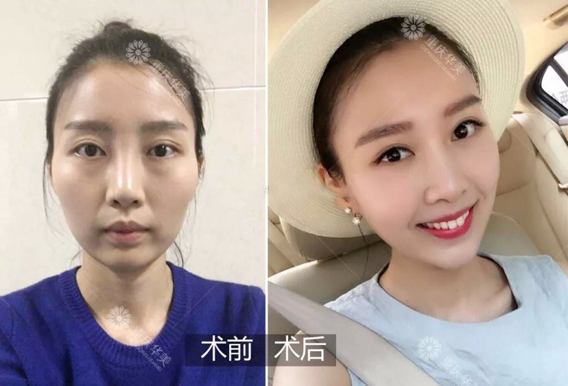 而亚洲人的面部普遍比较扁平,立体感不强,因此颧骨高不会显现出欧美