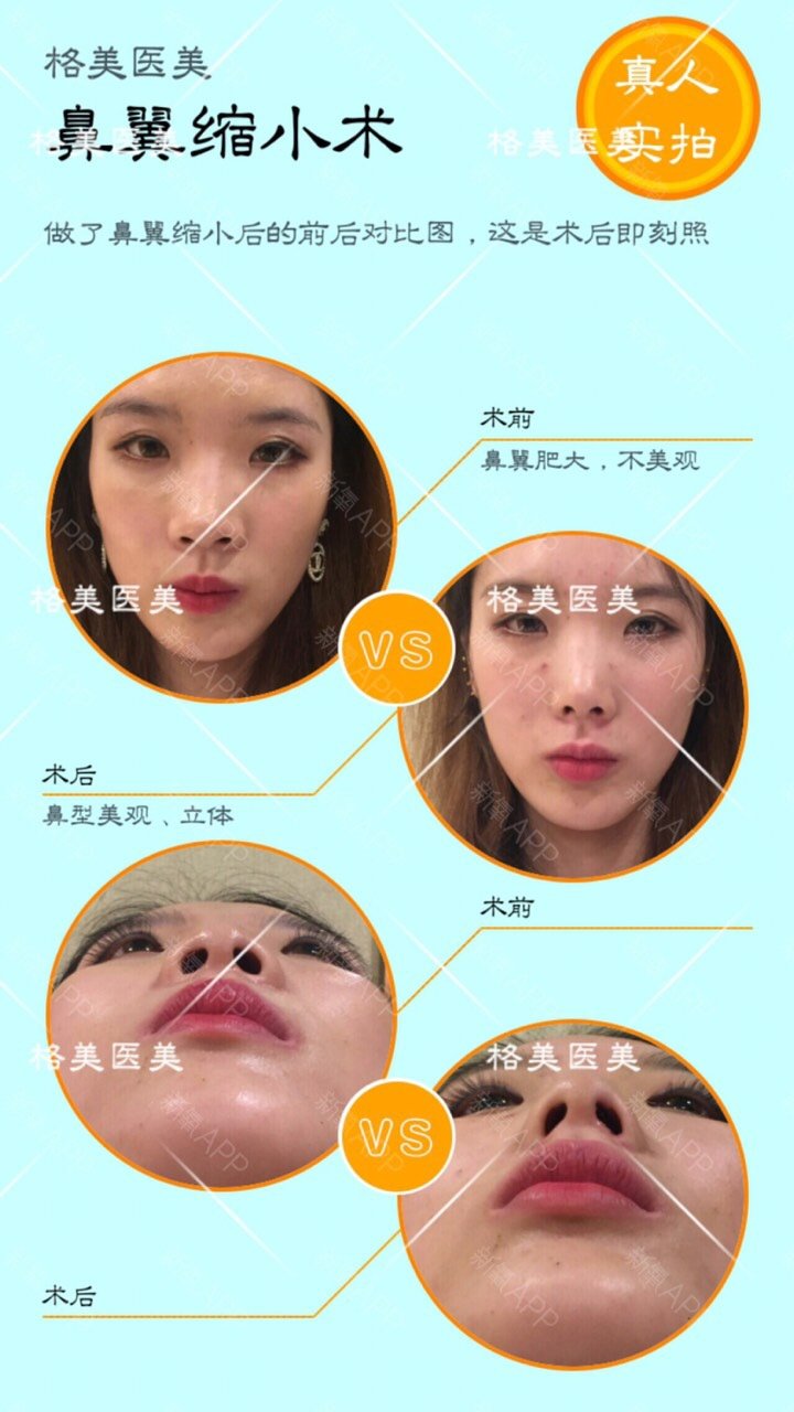 鼻翼缩小是内切好还是外切好,会不会增生呢?