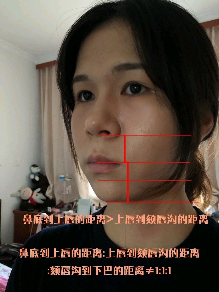 人中长 不知道是不是因为牙齿的问题导致的凸嘴 泪沟和法令纹很深
