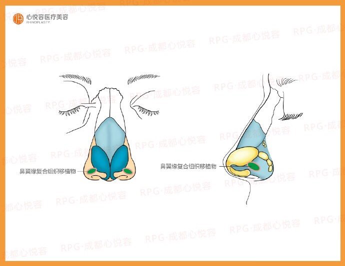 鼻孔漏怎么办