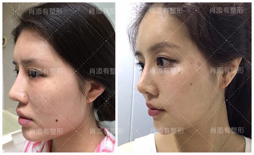 左右脸大小脸,想做削骨瘦脸,风险大吗?