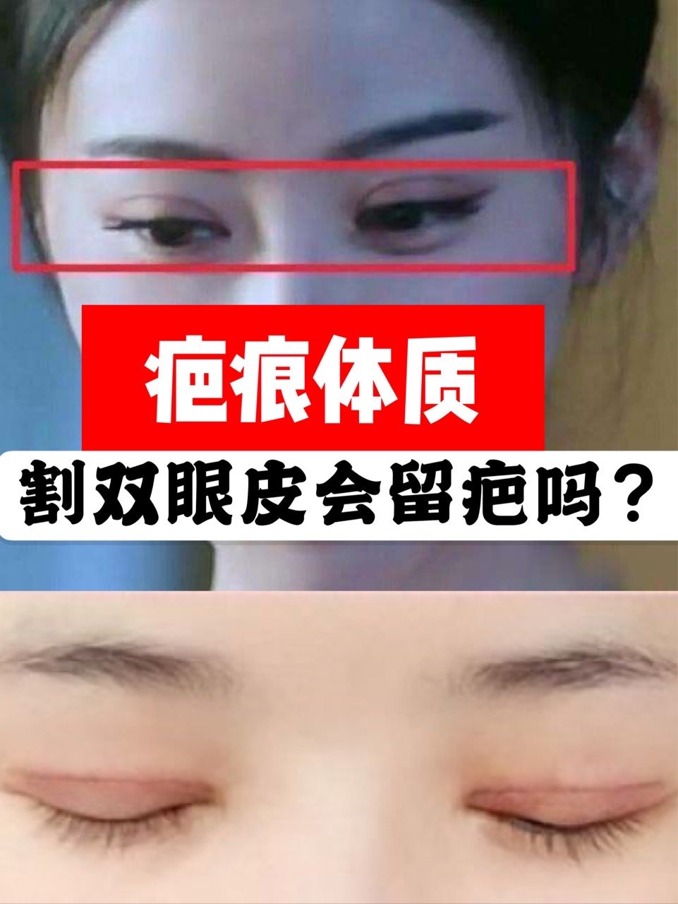 很多宝宝会问我:我是疤痕体质,割双眼皮会留疤吗?