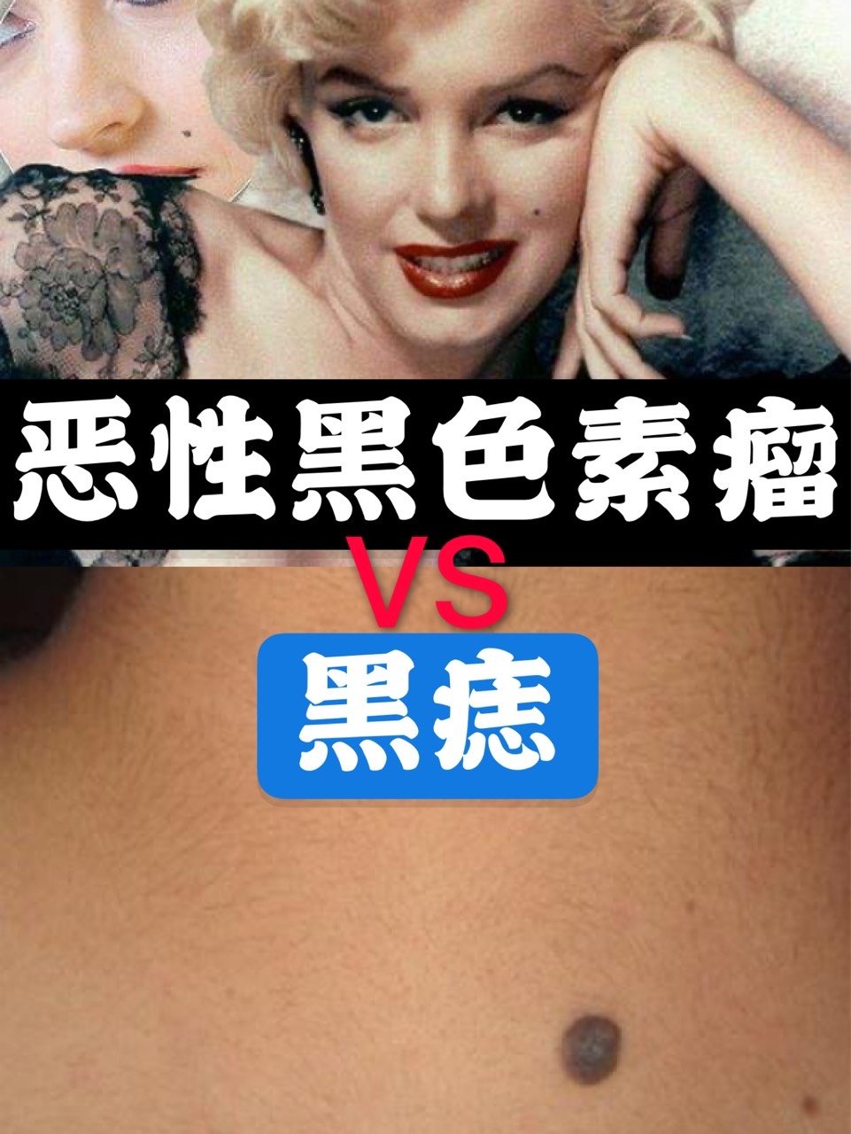 恶性黑色素瘤和黑痣有何不同?