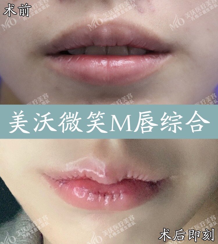 我的嘴唇比较长宽但是不会很厚如何找到适合我的方案m嘴唇合适吗