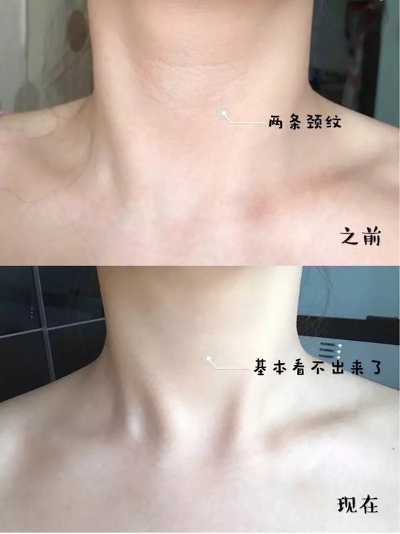 颈纹特别的深,要咋整?