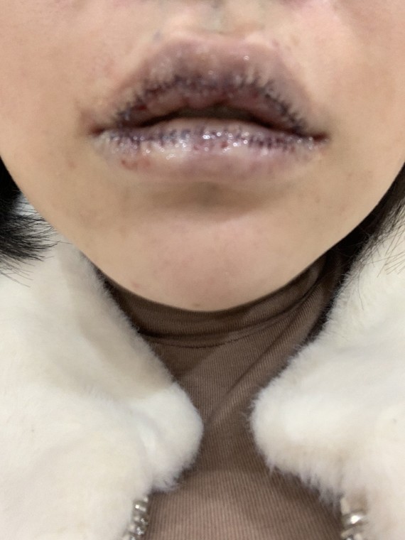 的m唇,觉得现在网红,遍大街都是,就做了厚唇改薄,上嘴唇稍微带点m唇