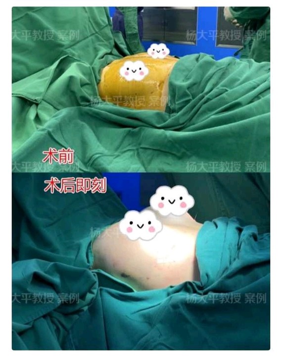 你好,假体隆胸切口常见的有三种:腋窝切口,乳晕切口和乳房下皱壁切口
